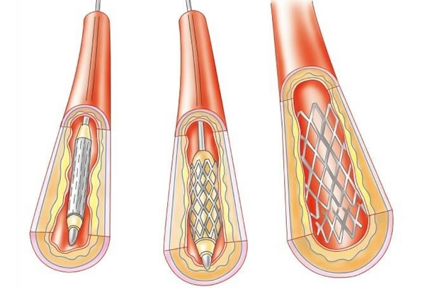 Angioplastia Coronária C/implante de Stent